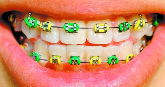 10 semne ca cel mic are nevoie de aparat dentar